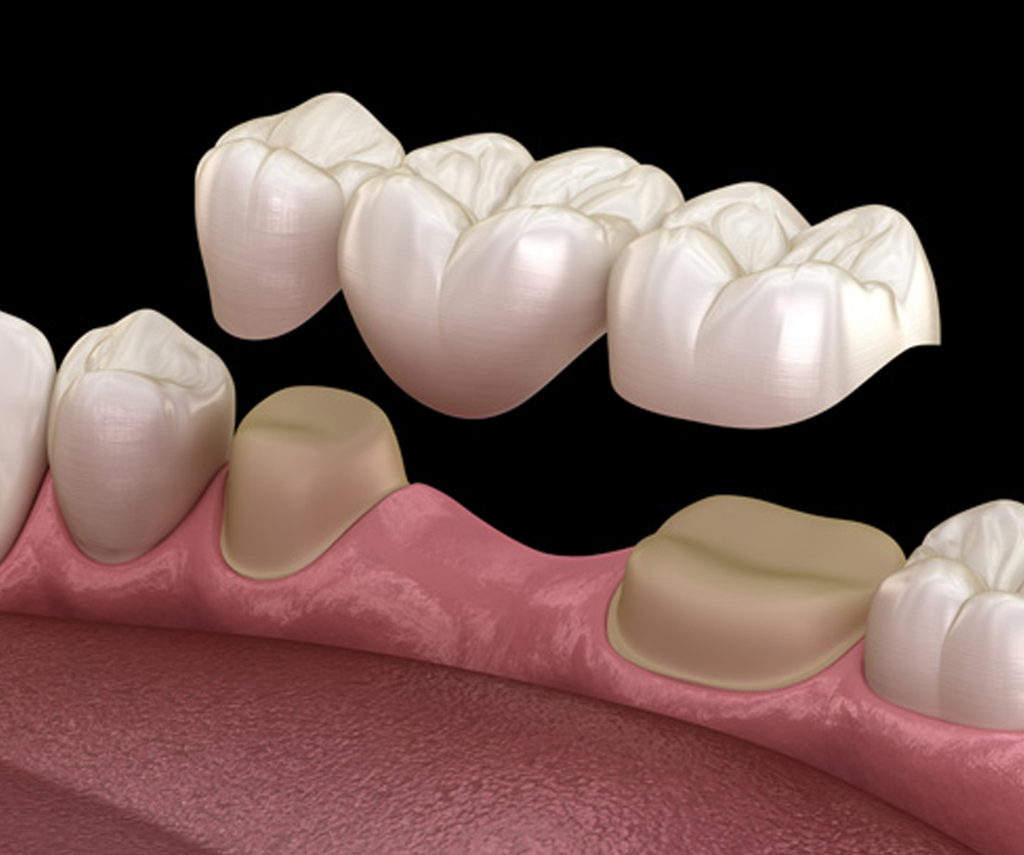 Zirconia & Ceramic Crowns and Bridges
